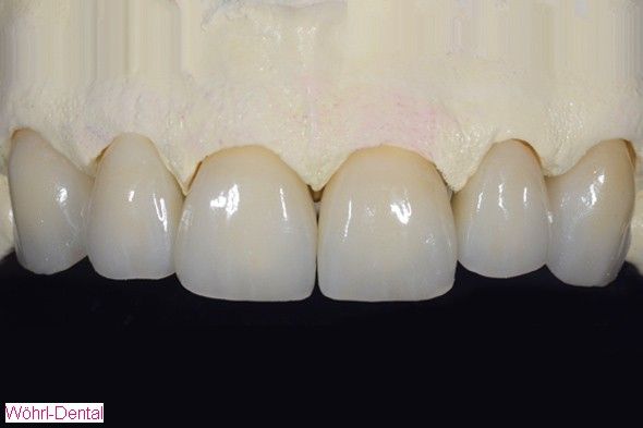 Wöhrl Dental Vollkeramik