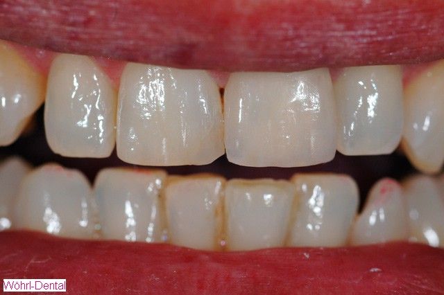 Wöhrl Dental Vollkeramik