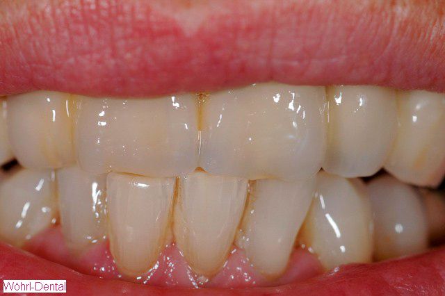 Wöhrl Dental Kombiarbeiten