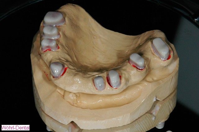 Wöhrl Dental herausnehmabre Brücken