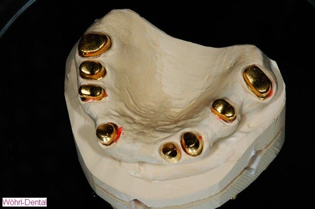 Wöhrl Dental herausnehmabre Brücken