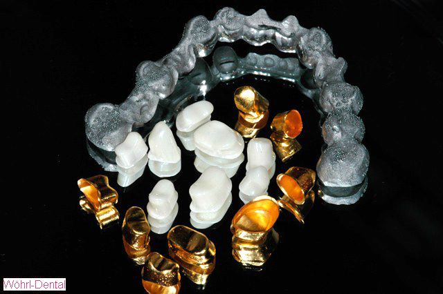 Wöhrl Dental herausnehmabre Brücken