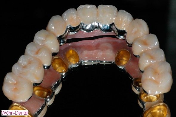 Wöhrl Dental herausnehmabre Brücken