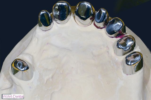 Wöhrl Dental Einstückgussverfahren Primärs