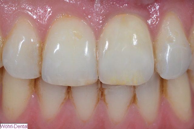 Wöhrl Dental Implantate CAD CAM