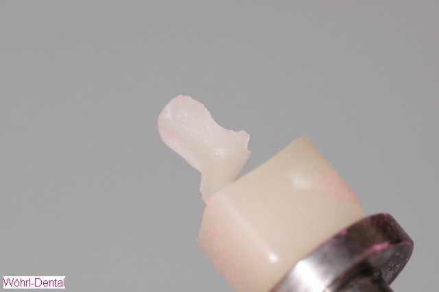 Wöhrl Dental Inlays