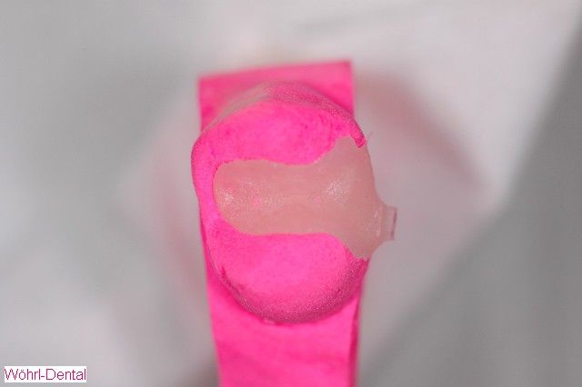 Wöhrl Dental Inlays