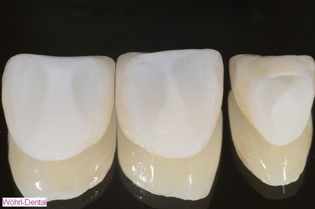 Wöhrl Dental Veneers