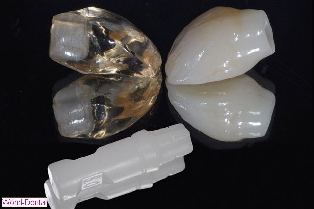 Wöhrl Dental Implantate CAD CAM